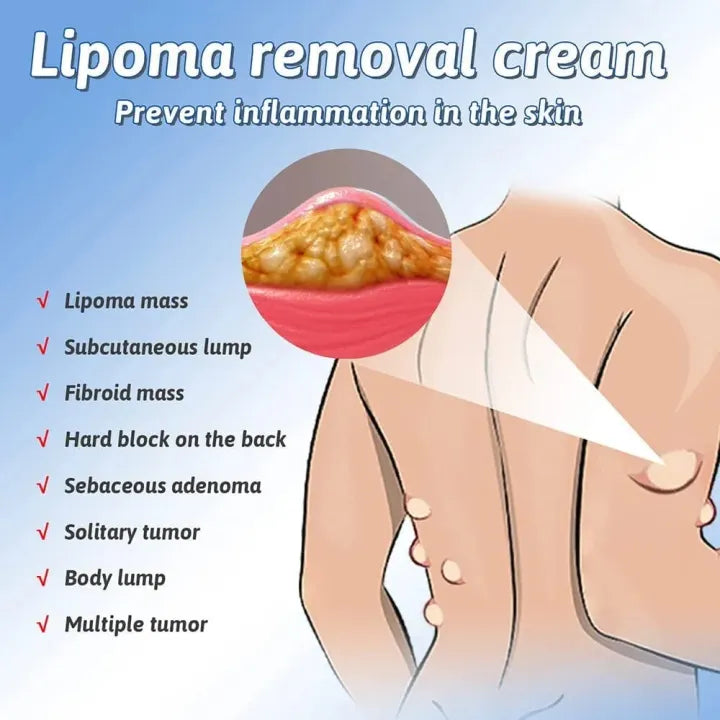 South Moon Lipoma Removal & Body Smoothing Cream - 50g